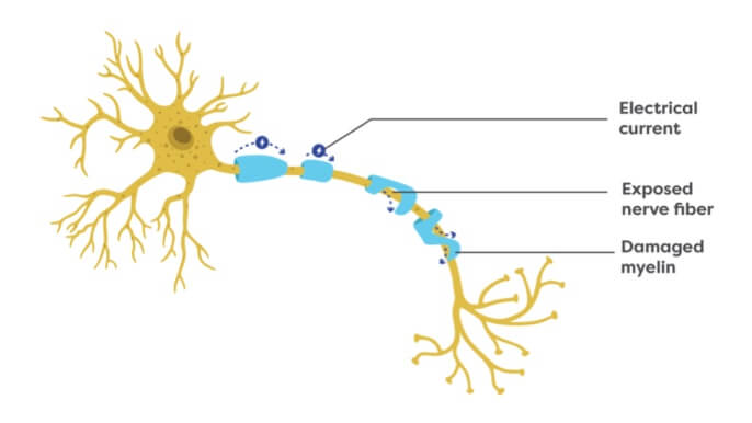 The message that flows through the neuron with CIDP is slowed down or lost due to the damaged myelin.