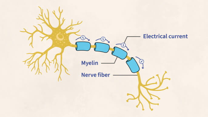 The message that flows through the neuron with CIDP is slowed down or lost due to the damaged myelin.