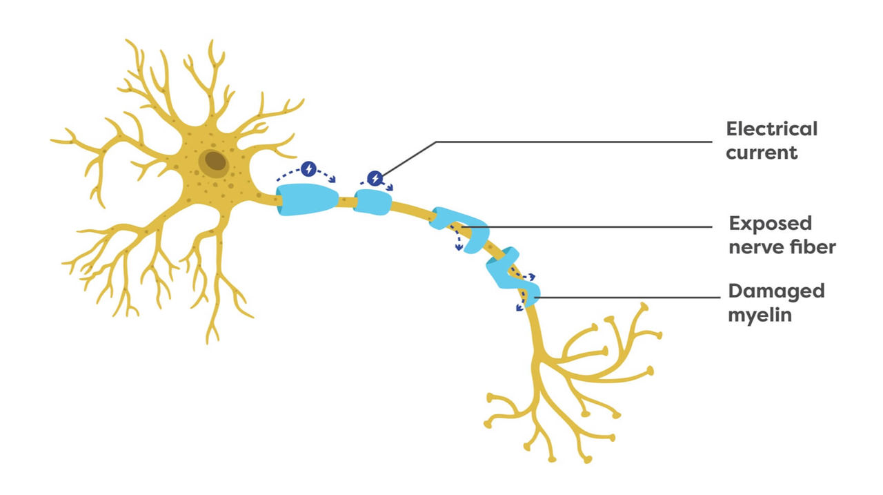 The message that flows through the neuron with CIDP is slowed down or lost due to the damaged myelin.
